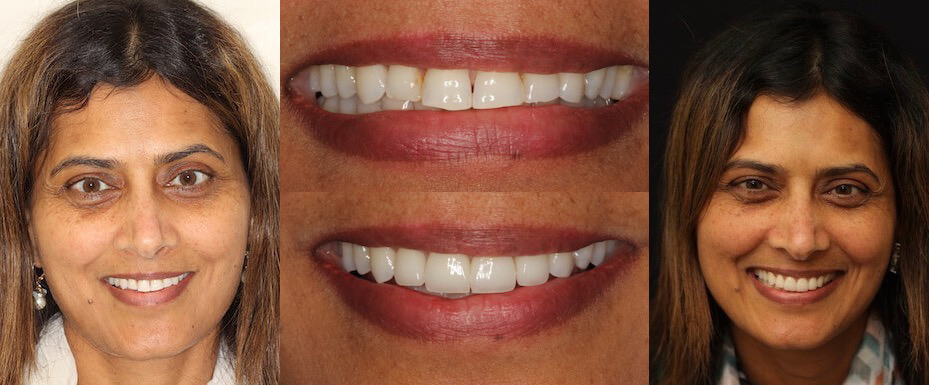 See the difference NYC smile design has made for Dr. Vishali Aygari