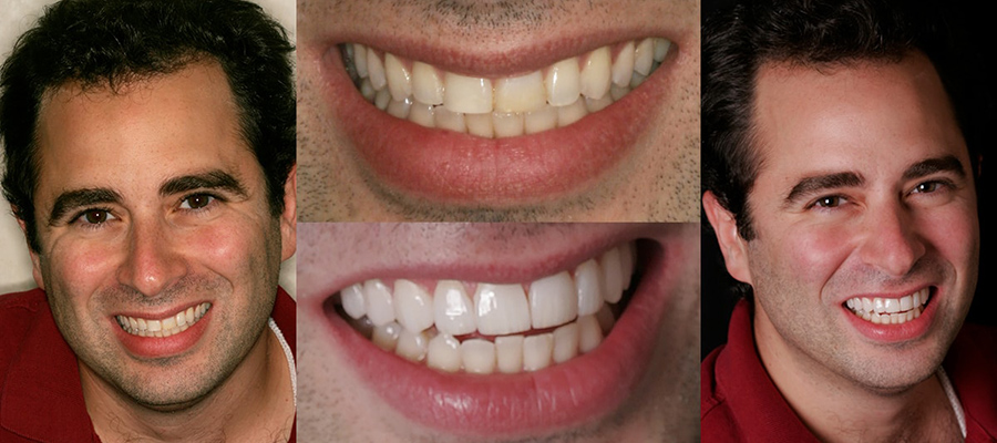 See the difference NYC smile design has made for Dr. Jonathan Abenaim