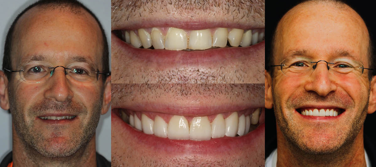See the difference NYC smile design has made for Dr. Anatoliy Ravin