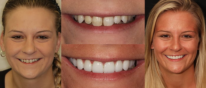 See the difference NYC smile design has made for Brieanna