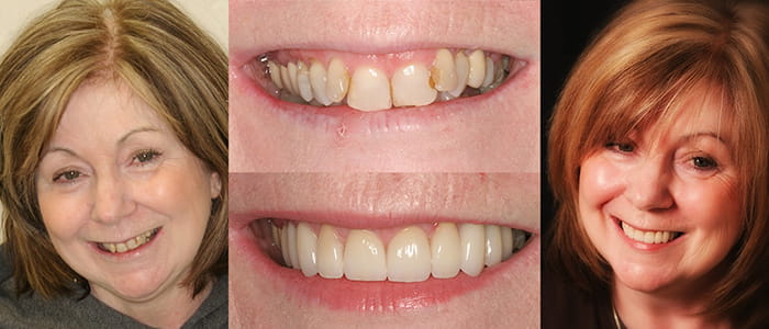 See the difference NYC smile design has made for Lynda.