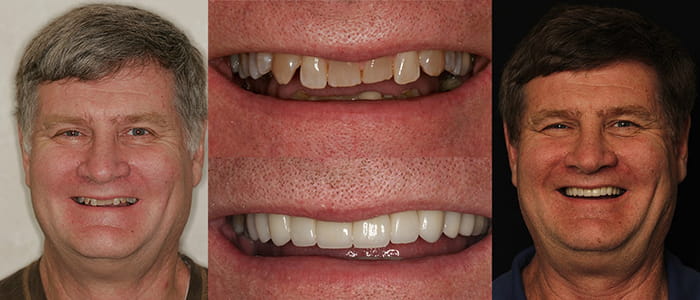 See the difference NYC smile design has made for Mark.