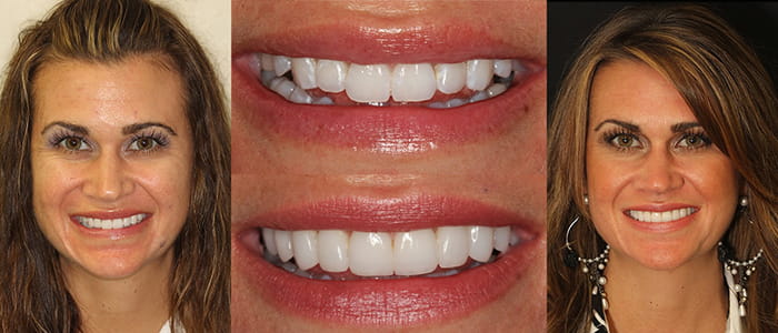 See the difference NYC smile design has made for Kristina.