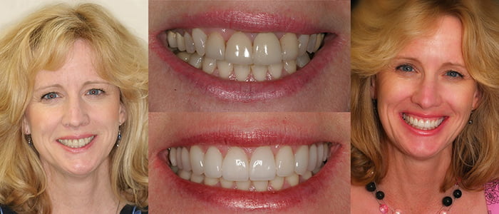 See the difference NYC smile design has made for Helen.