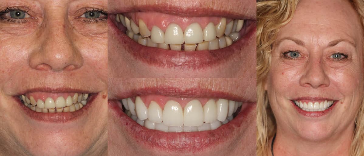 See the difference NYC smile design has made for Joanne.