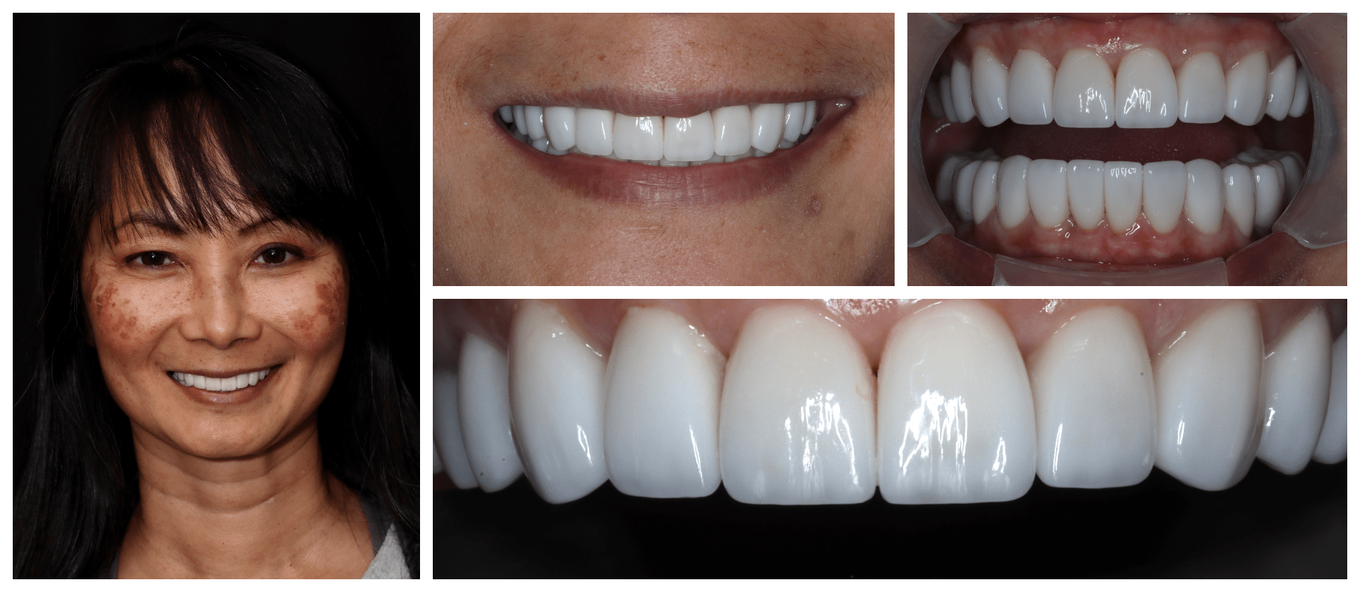 Before-and-after dental collage captures the heartwarming stories of transformed individuals, reflecting the expertise and care of our dental team